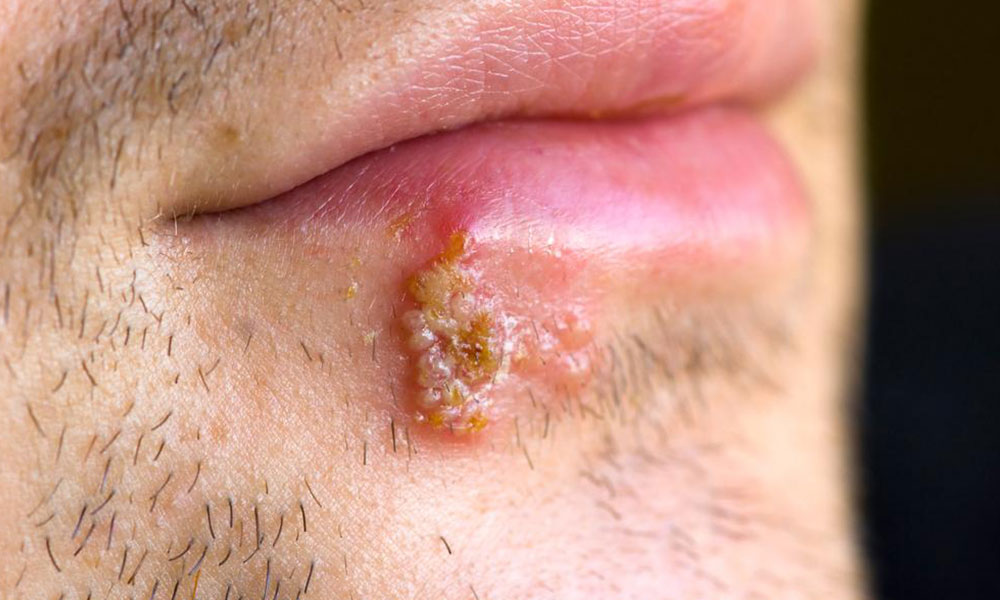 Blisters – Causes and how to heal blisters quickly